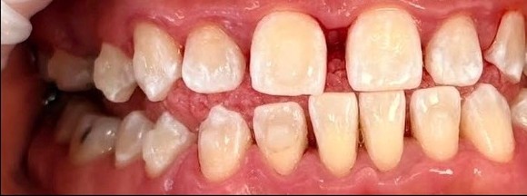 Cleaner teeth and healthier gums after scaling and root planing deep cleaning at Best Dental Spa