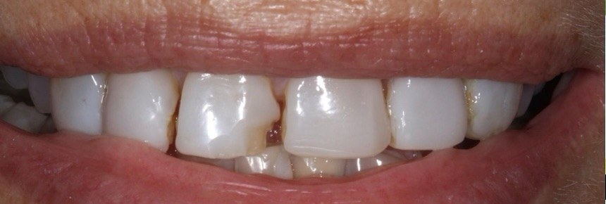 Chipped, uneven front teeth before zirconia crowns at Best Dental Spa