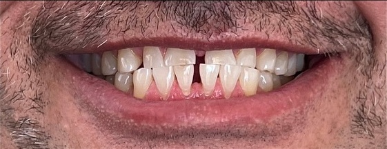 Smile before zirconia crown treatment at Best Dental Spa