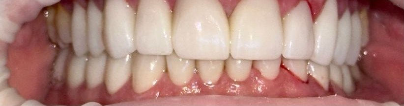 Full, natural-looking smile after zirconia crowns and implants at Best Dental Spa