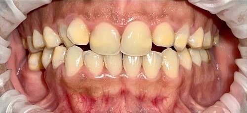 Uneven, discolored teeth before zirconia crown smile design at Best Dental Spa