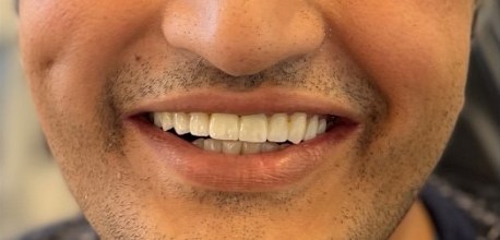 Full, natural-looking smile after a zirconia dental bridge at Best Dental Spa