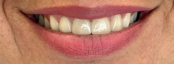 Natural-looking smile after zirconia crown smile makeover at Best Dental Spa
