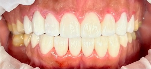 Even, bright smile after zirconia crown smile design at Best Dental Spa
