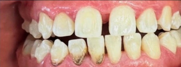 Teeth and gums before scaling and root planing deep cleaning at Best Dental Spa