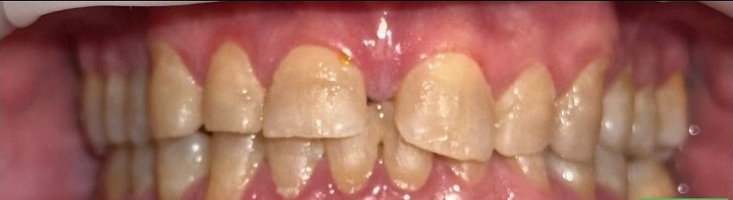Worn, discolored teeth before zirconia crowns and implants at Best Dental Spa
