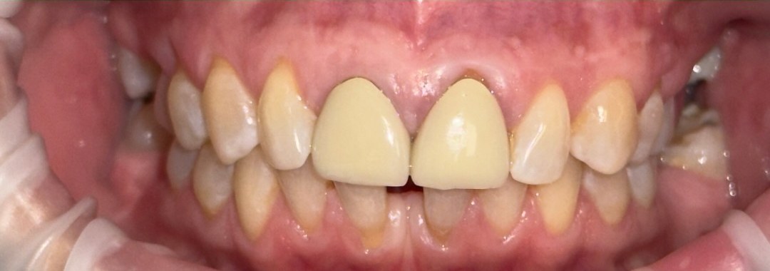 Old crowns and gapped teeth before smile makeover at Best Dental Spa