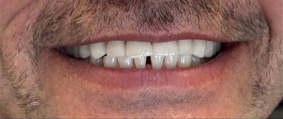 Smile after zirconia crown treatment at Best Dental Spa