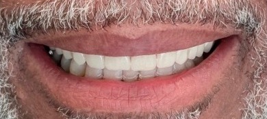 Restored natural-looking smile after smile makeover at Best Dental Spa