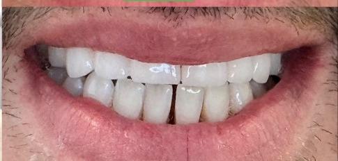 Brighter, even smile after smile makeover at Best Dental Spa