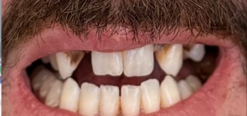 Discolored and uneven teeth before smile makeover at Best Dental Spa