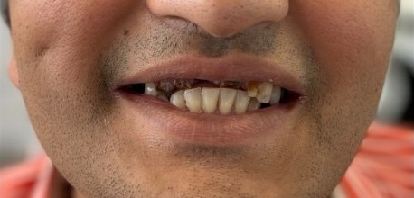 Damaged and missing teeth before a zirconia dental bridge at Best Dental Spa