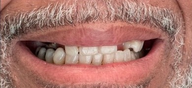 Worn and damaged teeth before smile makeover at Best Dental Spa