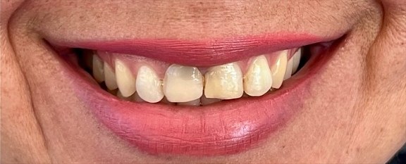 Discolored front teeth before zirconia crown smile makeover at Best Dental Spa