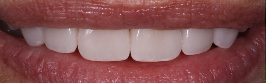 Smooth, even smile after zirconia crowns at Best Dental Spa
