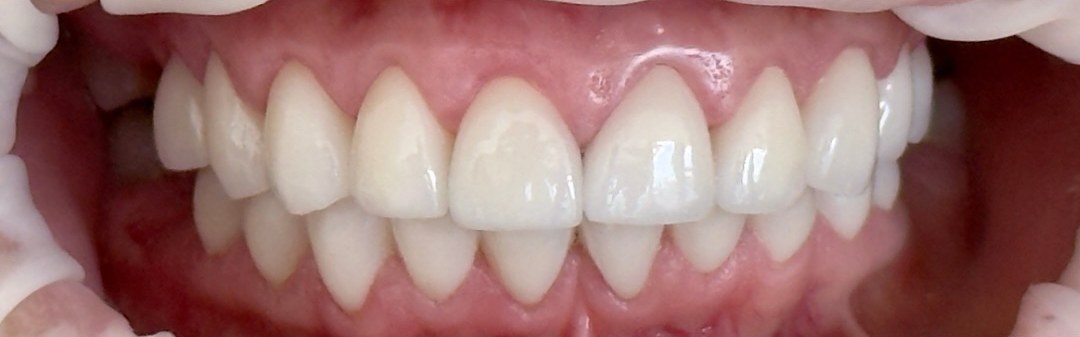 Full, even smile after smile makeover at Best Dental Spa